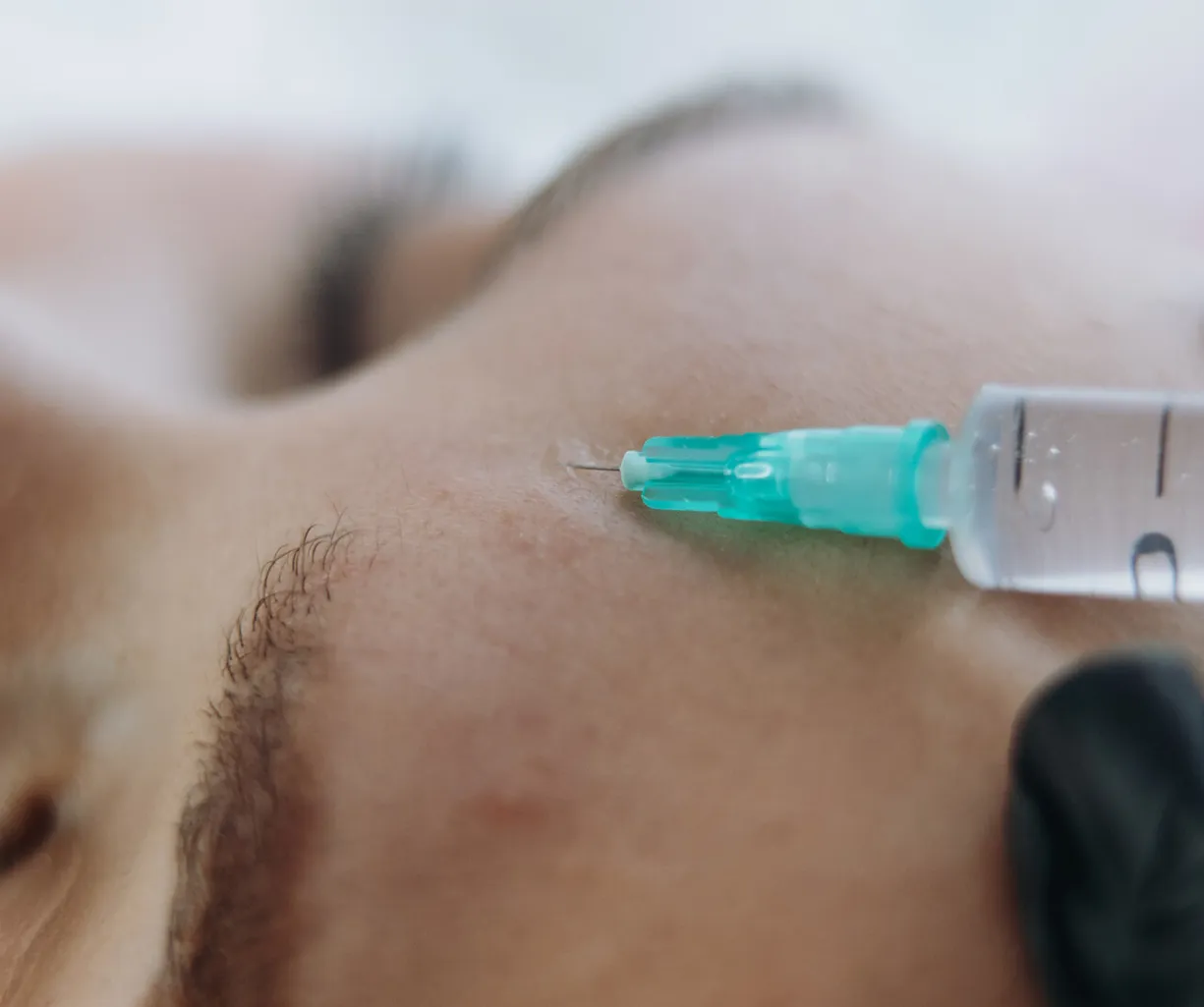 Nahaufnahme eines Augenbereichs mit aufgesetzter Einwegspritze, grünem Luer-Ansatz und Hautoberfläche; medizinischer Eingriff/Behandlung in einem Detailausschnitt.