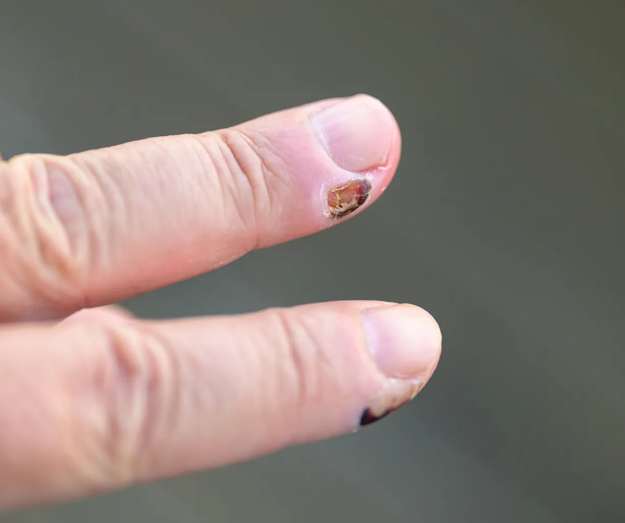 Nahaufnahme eines menschlichen Fingers mit einem beschädigten Fingernagel, der eine braune Verfärbung aufweist. Der Finger ist in einer gestreckten Position und zeigt die Nageloberfläche sowie die umliegende Haut.