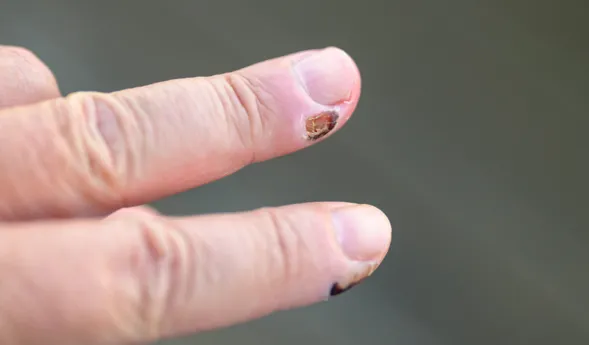 Nahaufnahme eines menschlichen Fingers mit einem beschädigten Fingernagel, der eine braune Verfärbung aufweist. Der Finger ist in einer gestreckten Position und zeigt die Nageloberfläche sowie die umliegende Haut.