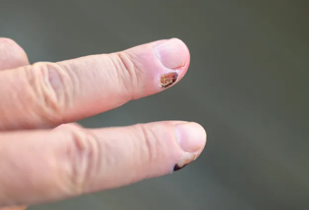 Nahaufnahme eines menschlichen Fingers mit einem beschädigten Fingernagel, der eine braune Verfärbung aufweist. Der Finger ist in einer gestreckten Position und zeigt die Nageloberfläche sowie die umliegende Haut.