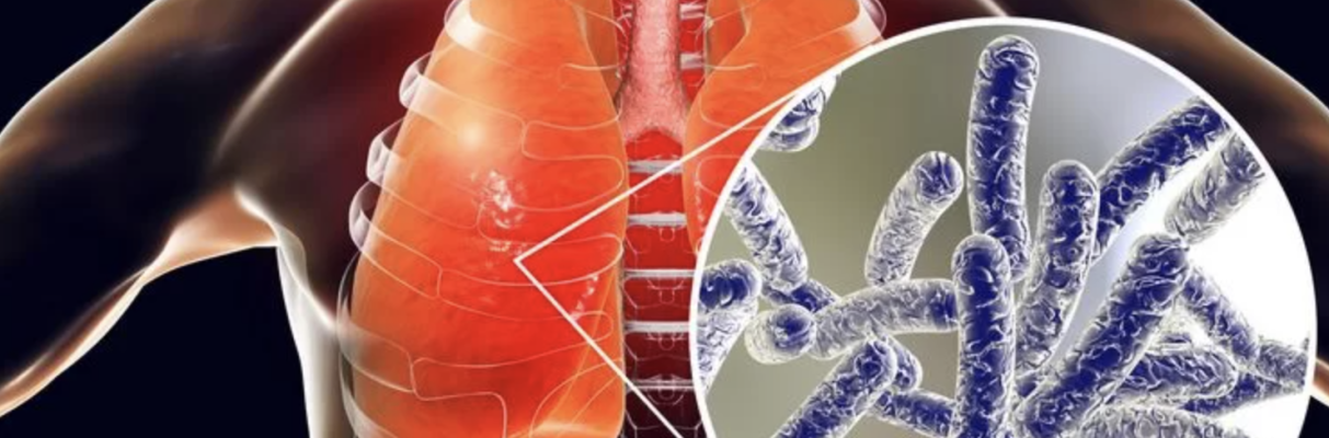 Legionellosis Cases Continue to Increase in Switzerland